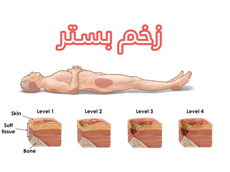 علل بروز زخم بستر و راه های درمان آن