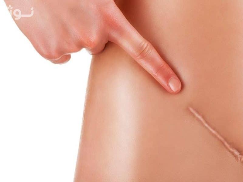 چگونه از زخم و جای زخم مراقبت کنیم؟