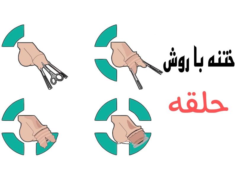 ختنه به روش حلقه تا چند ماهگی امکان پذیر است؟