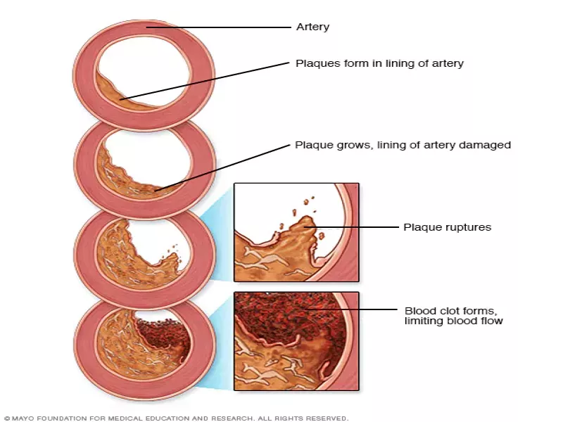 تفاوت آرتواسکلروسیز و آترواسکلروسیز(Arteriosclerosis and atherosclerosis)