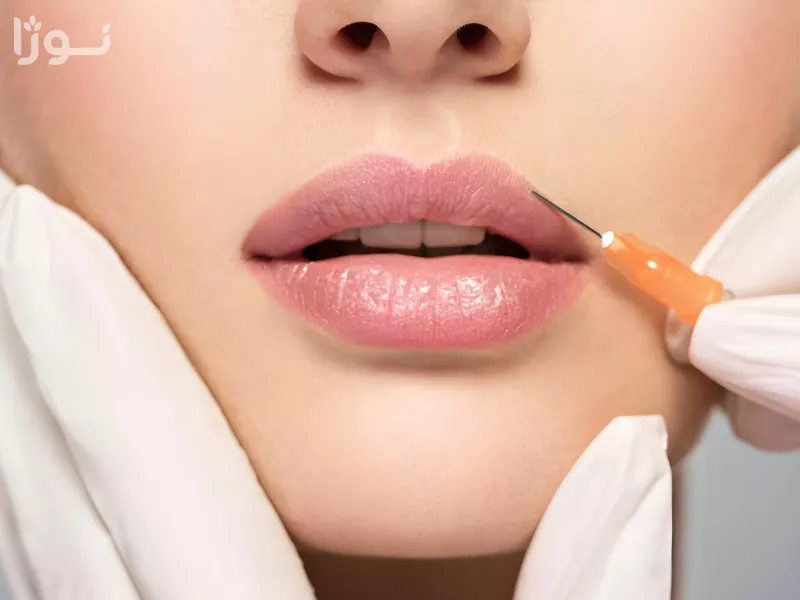 چگونه ورم بعد از تزریق ژل را از بین ببریم