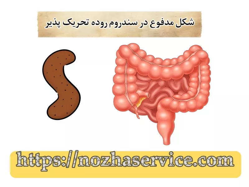 شکل مدفوع در سندروم روده تحریک پذیر