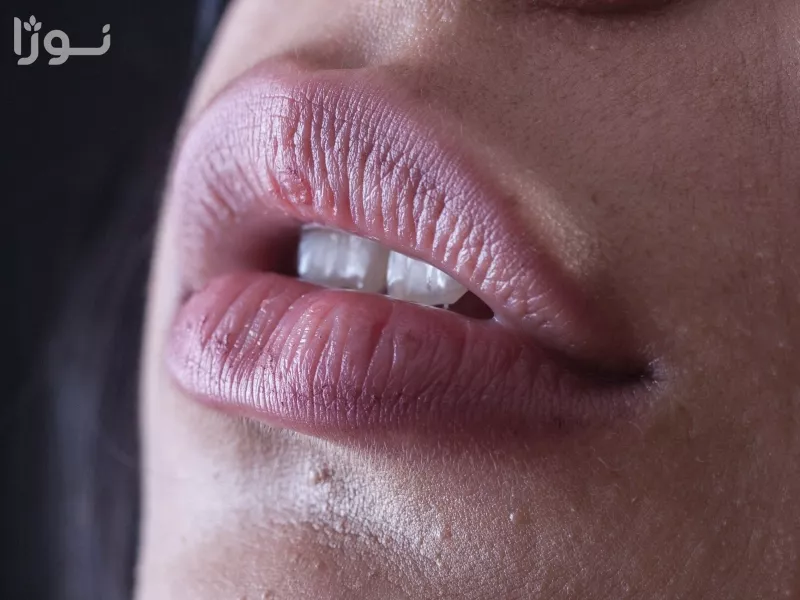 نکات مراقبتی پس از تزریق ژل - جلوگیری از ورم