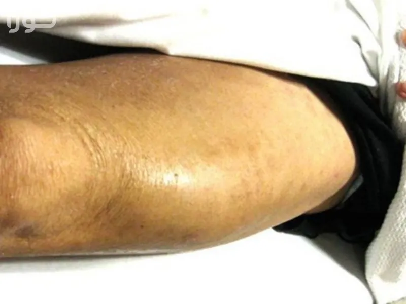 تشکیل آبسه تزریق عضلانی - علل و مکانیسم ایجاد عفونت پس از تزریق